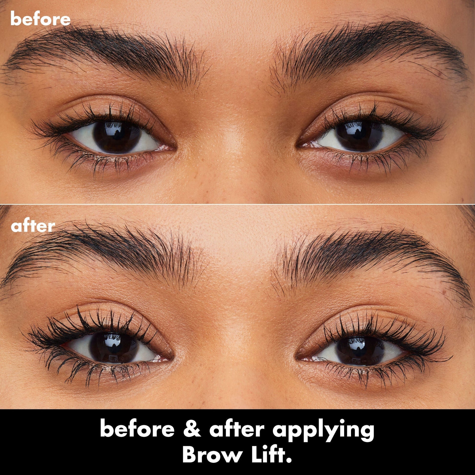 brow-lift-e4 0326_EDU_BrowLift_BA.jpg