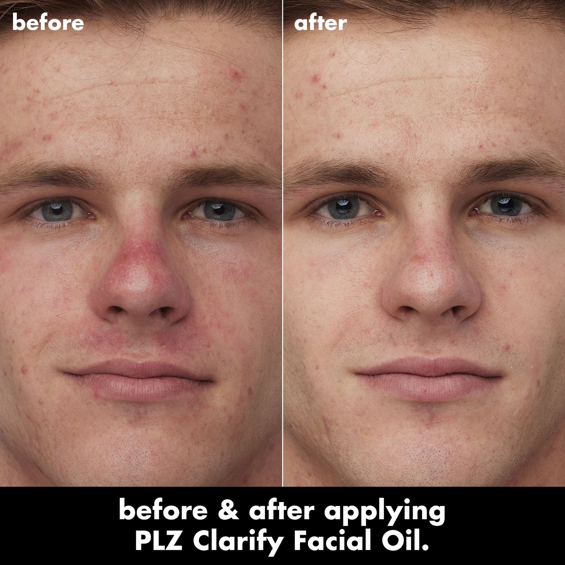 plz-clarify-facial-oil-o5 0326_EDU_PlzClarify_BA_Caleb.jpg
