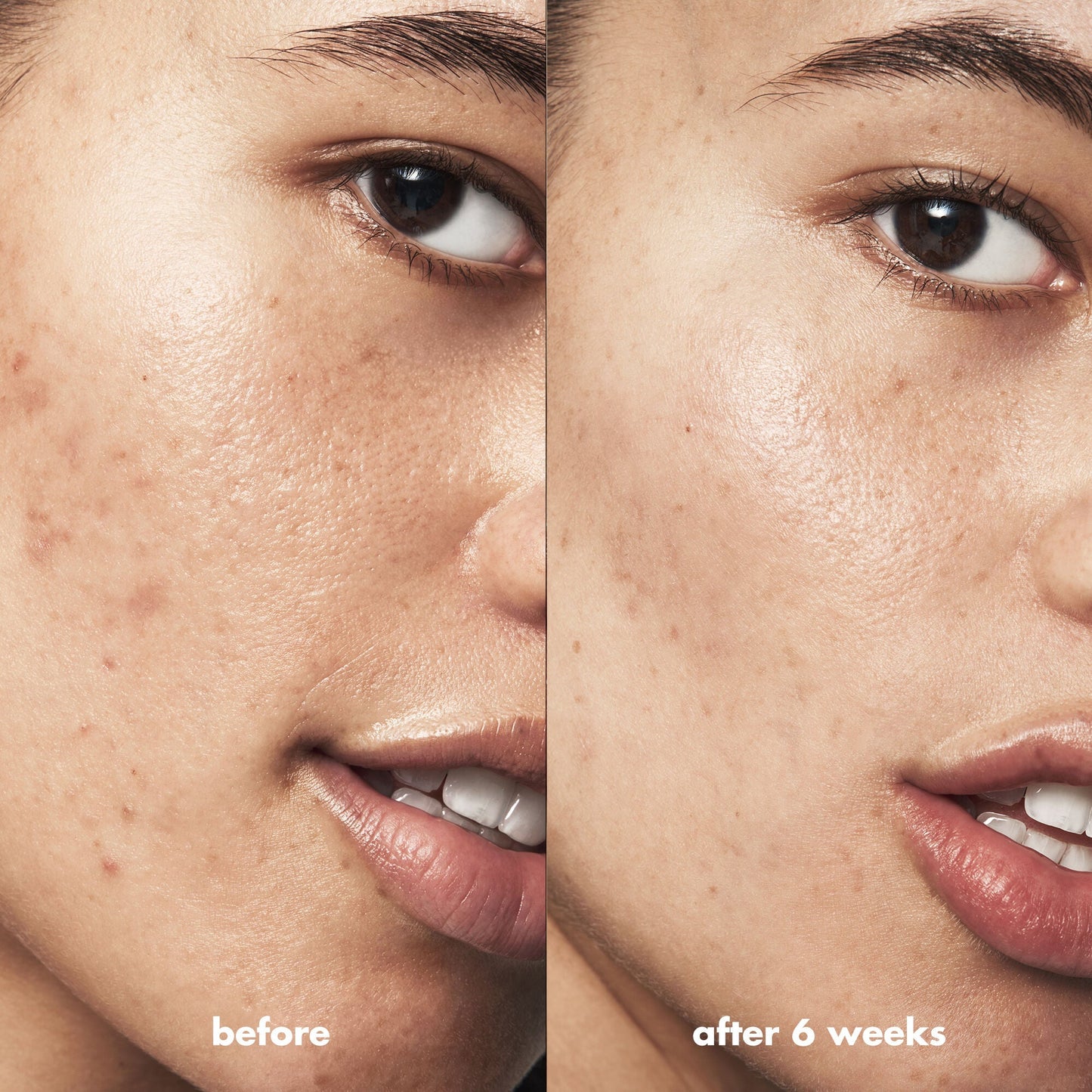 blemish-breakthrough-triple-acid-resurfacing-serum-g4 Acne_PDP_Isabella_Before_After_b8fe0505-ae5c-4baa-9a8e-fd889e4c3414.jpg