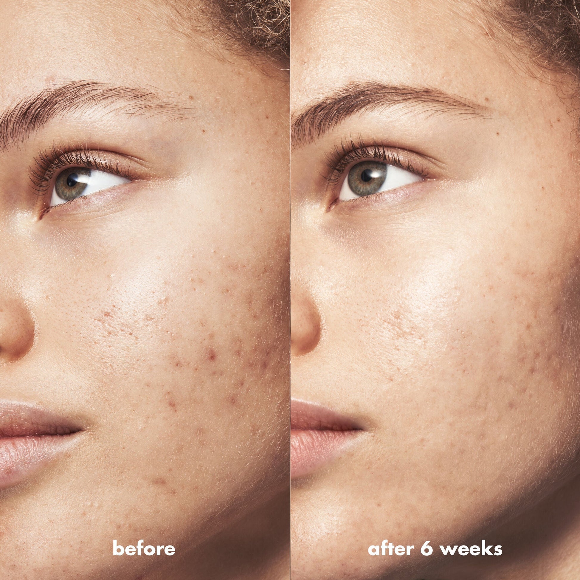 blemish-breakthrough-acne-clarifying-cleanser-d6 Acne_PDP_Marley_Before_After_216490cc-567c-424e-91eb-5374368f15d6.jpg